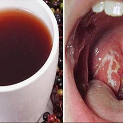 Remedios caseros para el dolor de garganta y tos