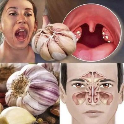 El ajo y su sorprendente poder para aliviar garganta y sinusitis