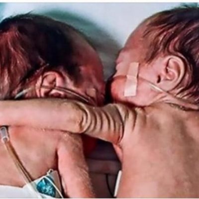 ¡Una enfermera pone a un bebé sano al lado de su gemelo moribundo y ocurre un verdadero milagro!