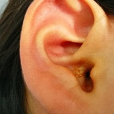 Cómo destapar los oídos: 4 trucos para terminar con la molestia